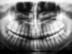 cirurgia ortognática